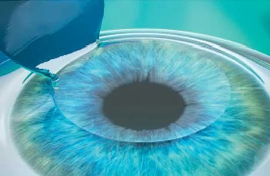 Lasik