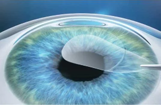 Laser Vision Correction